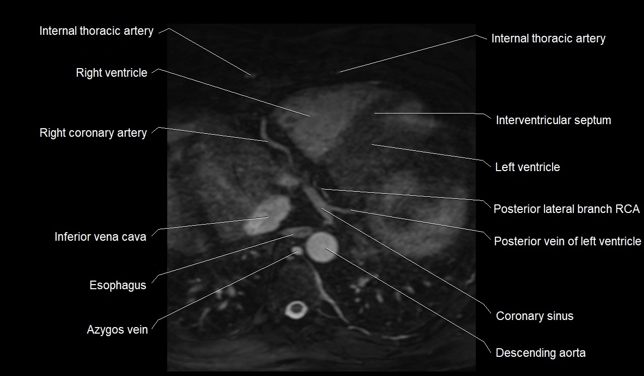MRI heart coronary arteries and coronary veins anatomy axial image 38.webp